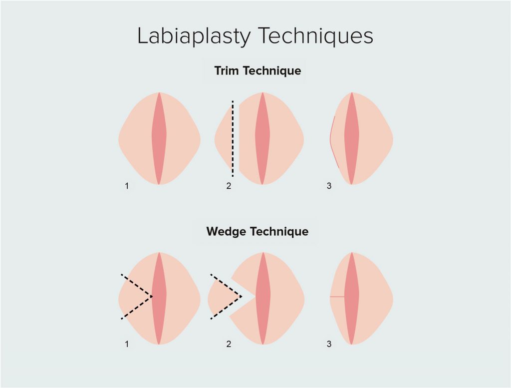 تنواع روش های جراحی لابیاپلاستی